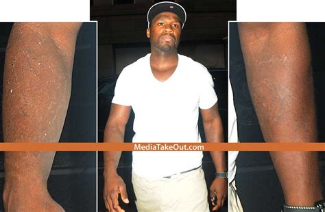 50 cent removes tattoos before and after, by. 50 Cent had all the tattoos on his arm removed. What his ...