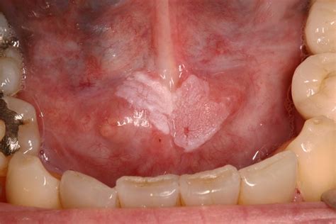 Oral Squamous Cell Carcinoma Floor Of Mouth