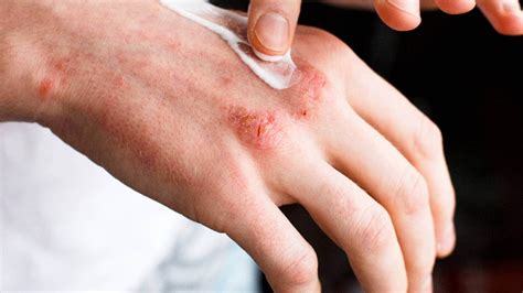 Psoriasis And Mental Health Know How This Skin Disease Is Linked To