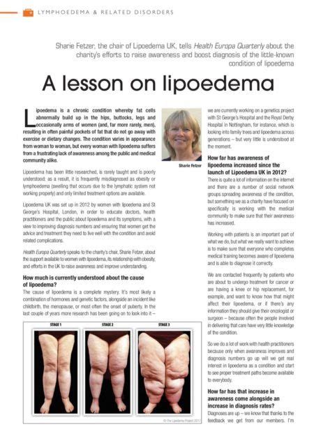 Lipoedema Uk 0098 Lipedema Treatment Lymphoedema Lymphatic Massage