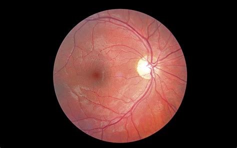 Retinal Photography To Calculate Risk The Biomedical Scientist