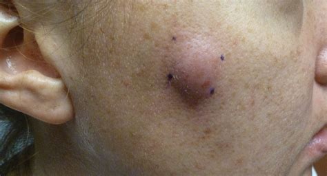 Mycobacterium Abscessus Infection Following Home Dermabrasion Mdedge