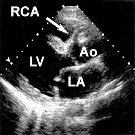 Anomalous Origin Of The Left Coronary Artery From The Main Pulmonary