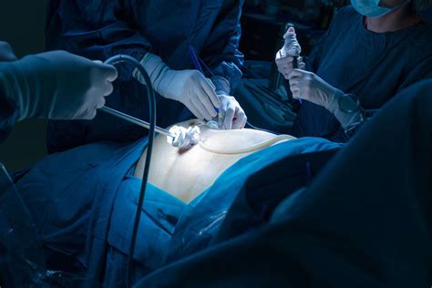 Hiatal Hernia Surgery What To Expect On The Day Of Surgery