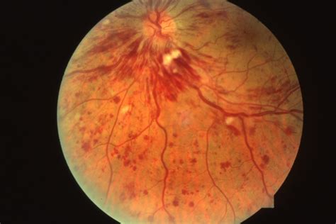 Central Retinal Vein Occlusion