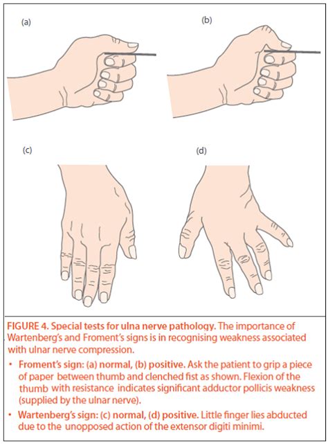 Froments Sign Flexion Of Thumb Ip With Lateral Pinch Sign Of Ulnar Nerve Issue And
