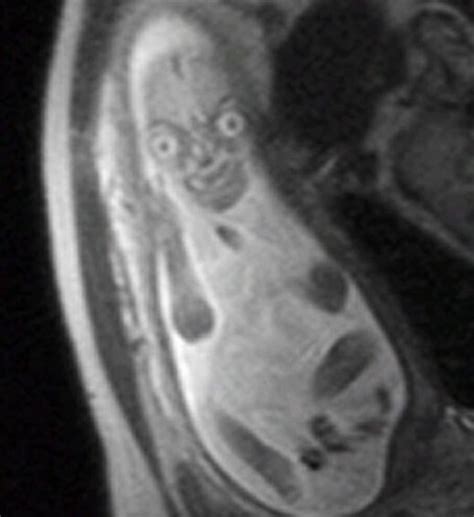 Doctors Dont Want You To See Pregnancy Mris Because Theyre Terrifying