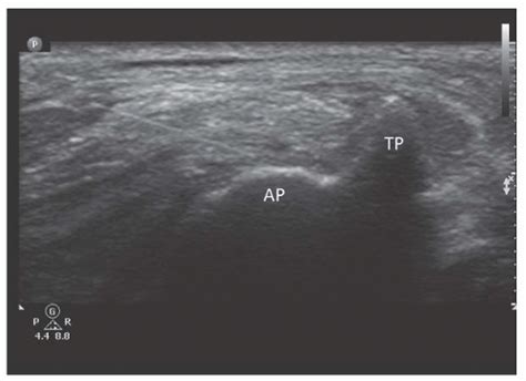 Ultrasound Guided Third Occipital Nerve Block And Cervical Medial