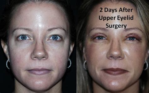 Before And After Upper Eyelid Surgery Pictures Gainesville Face Lift