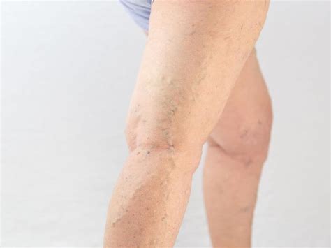 Spider Veins Vs Stretch Marks Whats The Difference Vein Envy™
