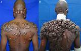 Keloid Removal Doctors Images