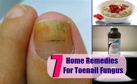 7 Home Remedies For Toenail Fungus Toenailfunguslavender Toenail