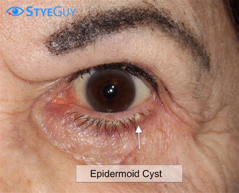 Eyelid Cyst
