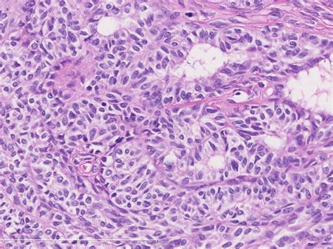 Pathology Outlines Uterine Tumors Resembling Ovarian Sex Cord Tumors