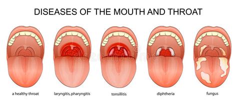 Diseases Of The Throat Stock Vector Illustration Of