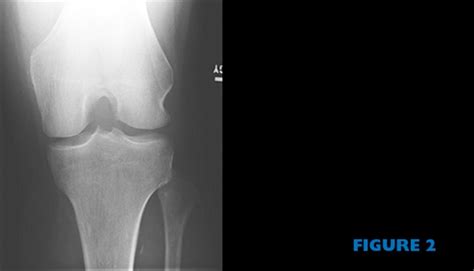 Ortho Dx Severe Pain Inability To Bear Weight On The Knee Clinical