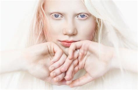 Albinismo Ecco Cosa Significa E Come Si Trasmette My Xxx Hot Girl