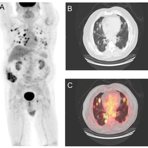 A Maximum Intensity Projection B Axial Ct And C Fused Petct Scans