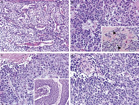 Representative Histologic Features Of Neuroendocrine Tumors Of The Lung
