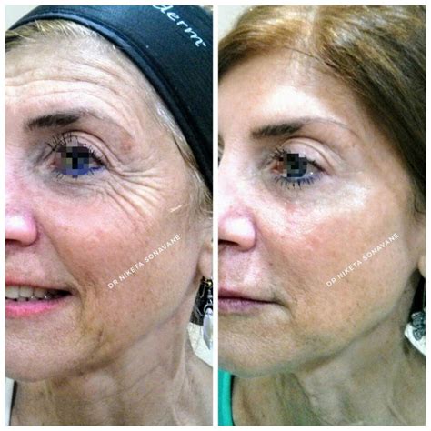 Full Face Botox In Yr Old Female By Top Dermatologist In Mumbai Dr