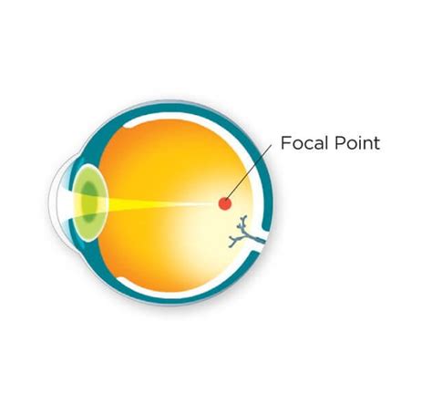 Nearsightedness Treatments Myopia Iris Ophthalmology Clinic