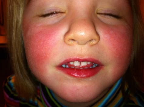 Toddler Facial Rashes Pictures Photos