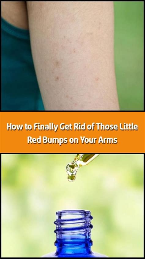 How To Get Rid Of Itchy Red Bumps On Skin