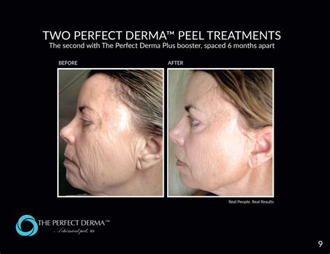 Chemical Peel Perfect Derma Peel Gilbert Az Onyx Integrative Med