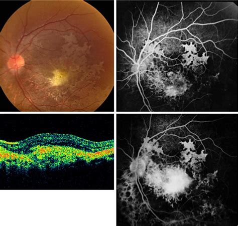 Figure 2 From A Case Of Choroidal Neovascularization Secondary To