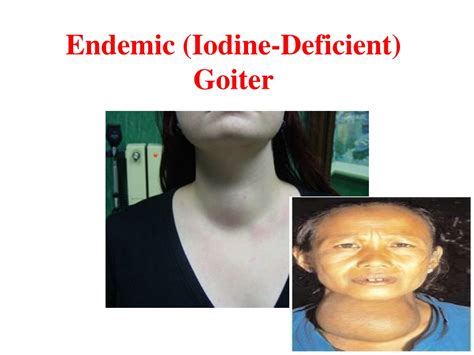 Ppt Assessment And Management Of Patients With Endocrine Disorders