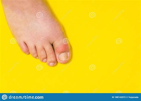 Gout On The Big Toe Appears As Redness And A Unbearable Pain Stock