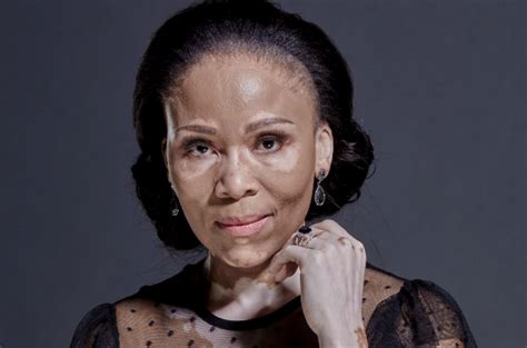 Leleti Khumalo On Her Skin Condition ‘i Used To Cover My White Patches