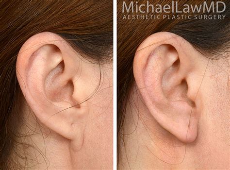 Ear Lobe Surgery Earlobe Repair Or Split Earlobe Surgery Is A Quick