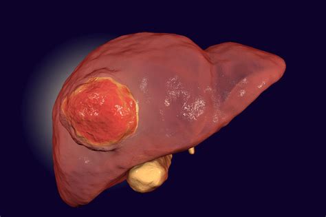 Rna Discovery May Lead To Better Diagnosis And Treatment Of Liver Cancer