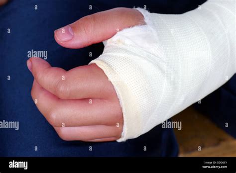 Broken Hand With Plaster Cast Close Up Stock Photo Alamy