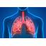 New Clues Discovered To Lung Transplant Rejection – Washington 