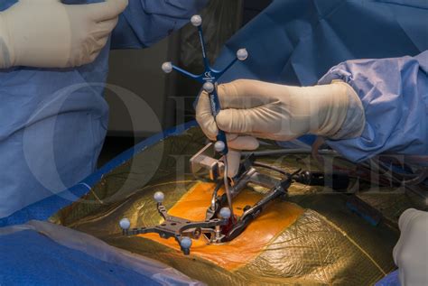 Minimally Invasive Posterior Lumbar Spine Fusion Midlif And Decompression For