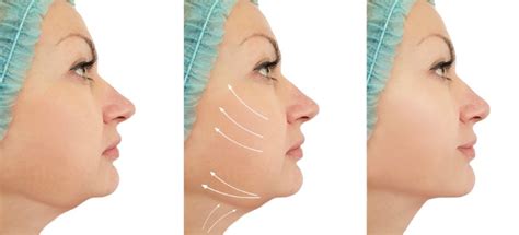 What Is The Best Procedure To Get Rid Of A Double Chin My Cosmetic Clinic