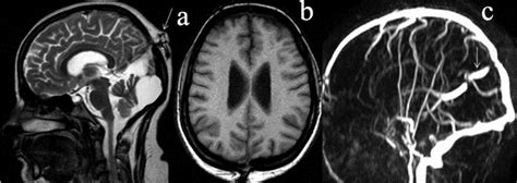 Atretic Occipital Cephalocele Sagittal T2wa Axial T1wb Image