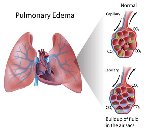 Pulmonary Edema Pediatric Pulmonologists