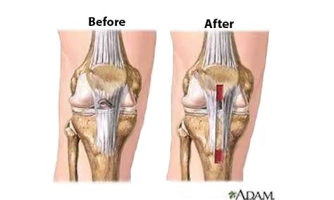 Acl surgery is the surgical reconstruction or replacement of the anterior cruciate ligament (acl) in the knee. Anterior Cruciate Ligament (ACL) Repair with Allograft ...