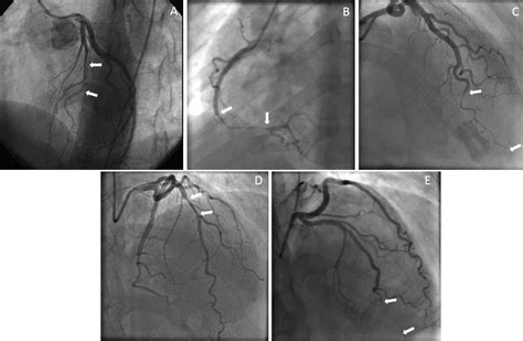 Spontaneous Coronary Artery Dissection Heart