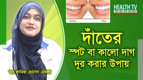 দতর সপট ব কলদগ দর করর উপয How to remove black stains on teeth Dr Fariha Meghla