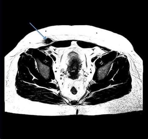 A Case Of Endometriosis Presenting As An Inguinal Hernia Bmj Case Reports