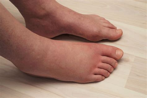 What Can Cause Swelling On Feet Explore The Treatments Healthwire