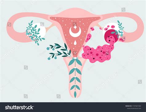 Women Health Floral Infographic Ovarian Cyst Stock Vector Royalty Free