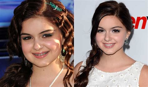 Celebrities With Braces Before And After Famous Brace Faces