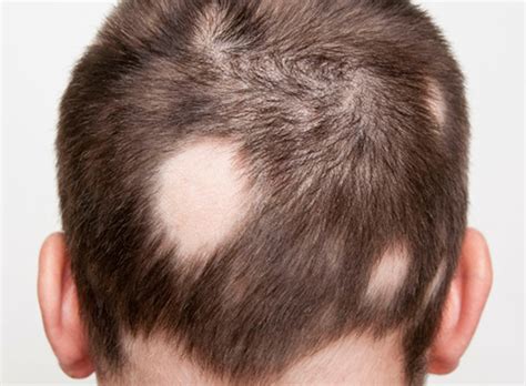 If you have it, there are alopecia home care. Alopecia - Attivazioni Biologiche