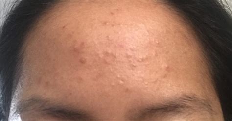How To Easily Get Rid Of Forehead Acne Market Share Group