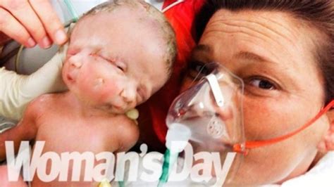 1 Body2 Facesrare Twins Born In Sydney
